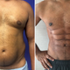 Preoperative frontal view (left) compared to image obtained 1-year postoperatively of a male patient with abdominal etching plus concomitant gynecomastia correction and deltoid/biceps augmentation (right).
